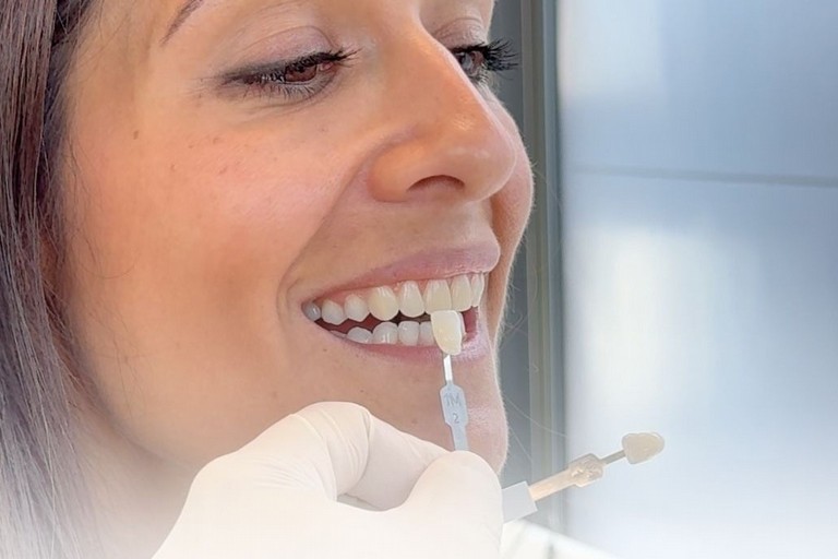 Faccette dentali